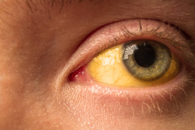 Jaundice