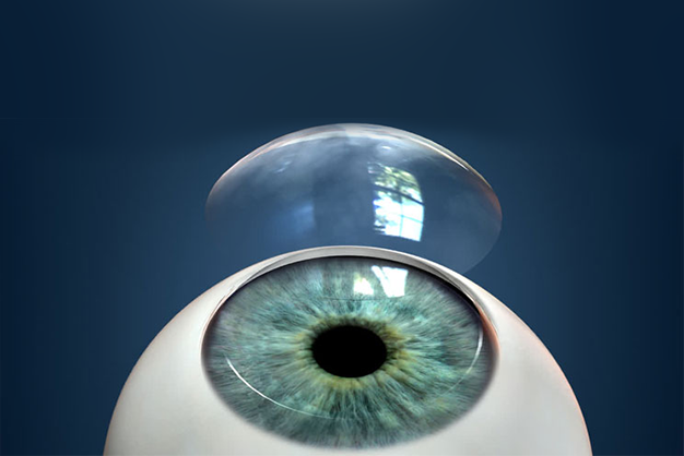 Corneal Transplantation: Restoring Vision through Surgery