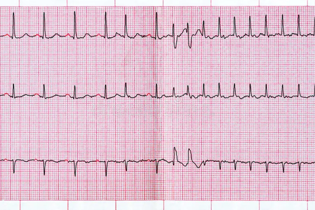 Atrial Fibrillation: Symptoms, Complications, and Treatment Options